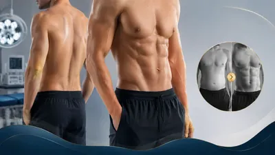 Male liposuction treatment areas - chest, flanks, abdomen and chin contouring for men